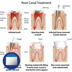 root canal treatment performed by an endodontist - with Colorado icon