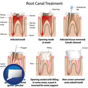 root canal treatment performed by an endodontist - with Connecticut icon