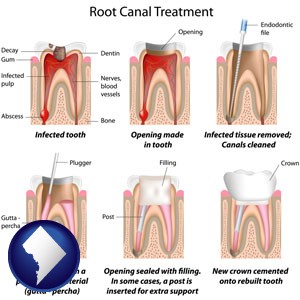 root canal treatment performed by an endodontist - with Washington, DC icon