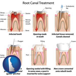 root canal treatment performed by an endodontist - with Delaware icon