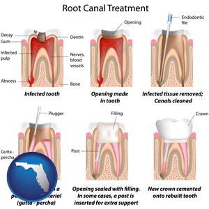 root canal treatment performed by an endodontist - with Florida icon
