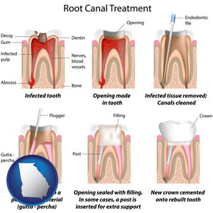 root canal treatment performed by an endodontist - with Georgia icon