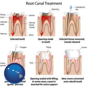 root canal treatment performed by an endodontist - with Hawaii icon