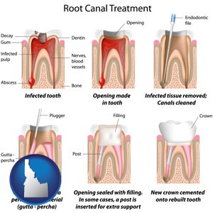 root canal treatment performed by an endodontist - with Idaho icon