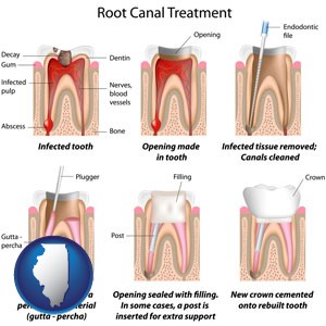 root canal treatment performed by an endodontist - with Illinois icon