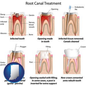 root canal treatment performed by an endodontist - with Indiana icon