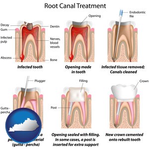 root canal treatment performed by an endodontist - with Kentucky icon