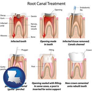 root canal treatment performed by an endodontist - with Louisiana icon