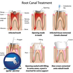 root canal treatment performed by an endodontist - with Massachusetts icon