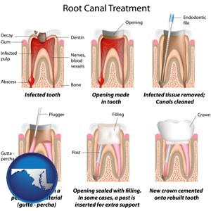 root canal treatment performed by an endodontist - with Maryland icon