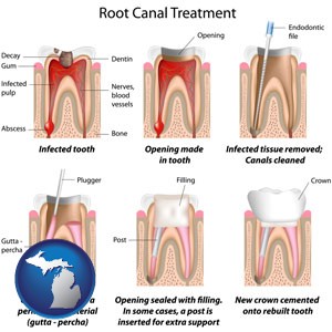root canal treatment performed by an endodontist - with Michigan icon