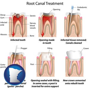 root canal treatment performed by an endodontist - with Minnesota icon