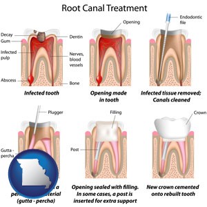 root canal treatment performed by an endodontist - with Missouri icon