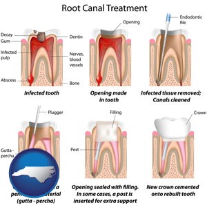root canal treatment performed by an endodontist - with North Carolina icon