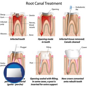 root canal treatment performed by an endodontist - with North Dakota icon
