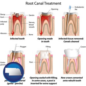 root canal treatment performed by an endodontist - with Nebraska icon