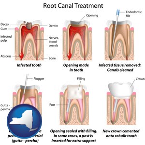 root canal treatment performed by an endodontist - with New York icon