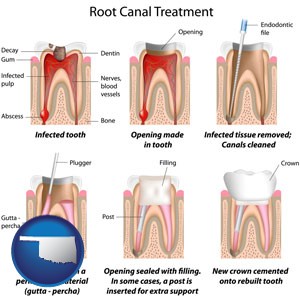 root canal treatment performed by an endodontist - with Oklahoma icon