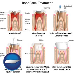 root canal treatment performed by an endodontist - with Tennessee icon