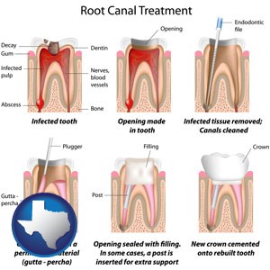 root canal treatment performed by an endodontist - with Texas icon