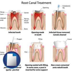 root canal treatment performed by an endodontist - with Utah icon