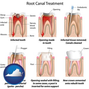 root canal treatment performed by an endodontist - with Virginia icon