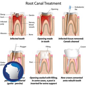 root canal treatment performed by an endodontist - with Wisconsin icon