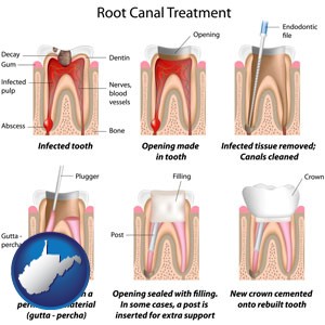 root canal treatment performed by an endodontist - with West Virginia icon