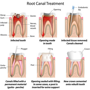 root canal treatment performed by an endodontist
