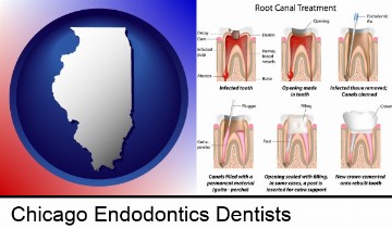 root canal treatment performed by an endodontist in Chicago, IL