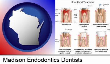 root canal treatment performed by an endodontist in Madison, WI