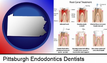 root canal treatment performed by an endodontist in Pittsburgh, PA